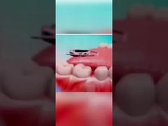 Edgewise Ortho ฟันบราคเกอร์ Molar แบนด์ สเปซ Maintainer กับสปริงชนิด