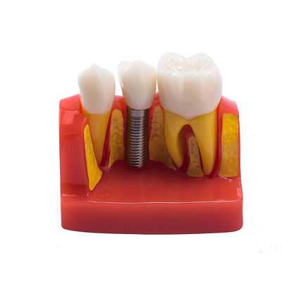 Class III Instrument Classification Dental Study Model for Dental Practice and Demonstration