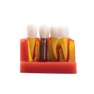 Class III Instrument Classification Dental Study Model for Dental Practice and Demonstration