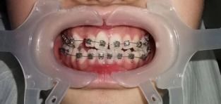 Multi Function Cheek Retractor Clear Large Medium Small for Dental Orthodontic Procedures
