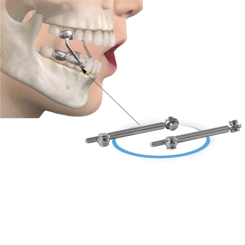 Herbst Appliance Jaw Corrector 18-31mm Stainless Steel Orthodontic